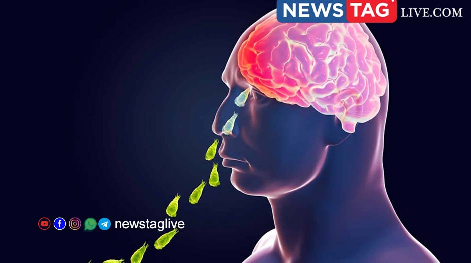 amebic meningoencephalitis