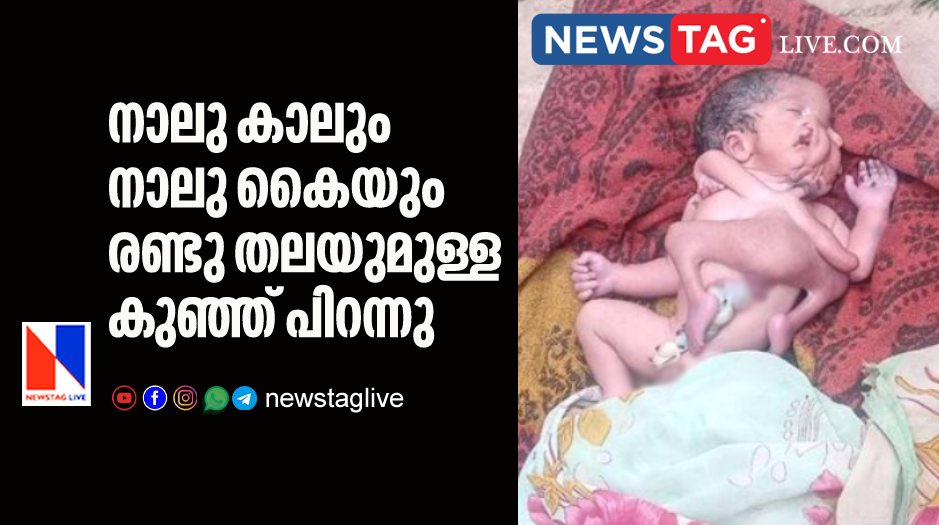 baby born with four legs four hands and two heads