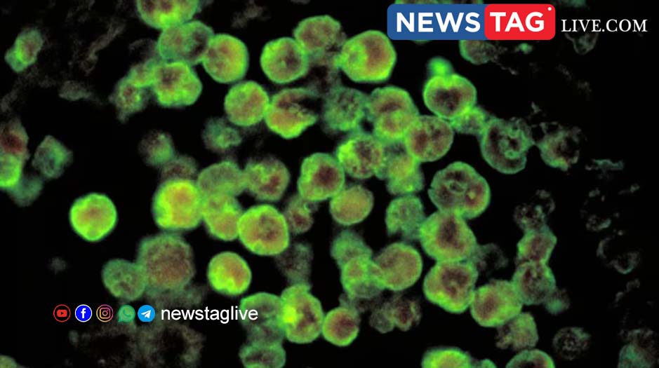 man tests positive for Amoebic meningoencephalitis in Kozhikkode