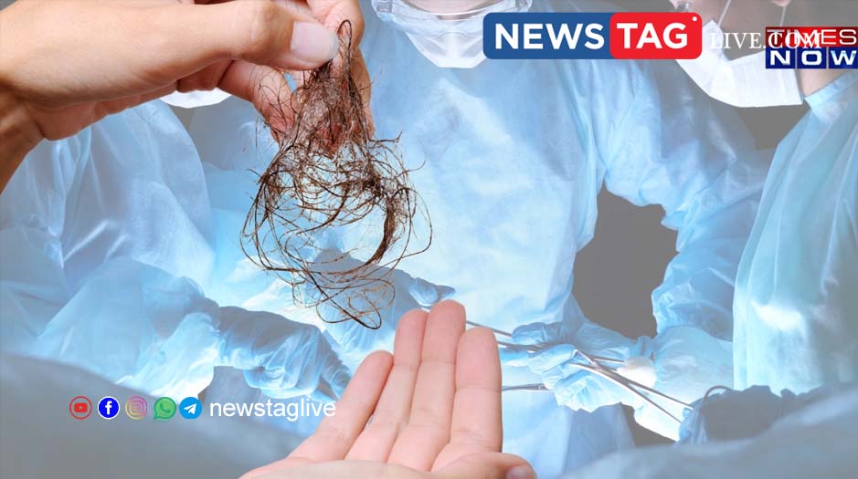 Trichophagia is compulsive eating of hair
