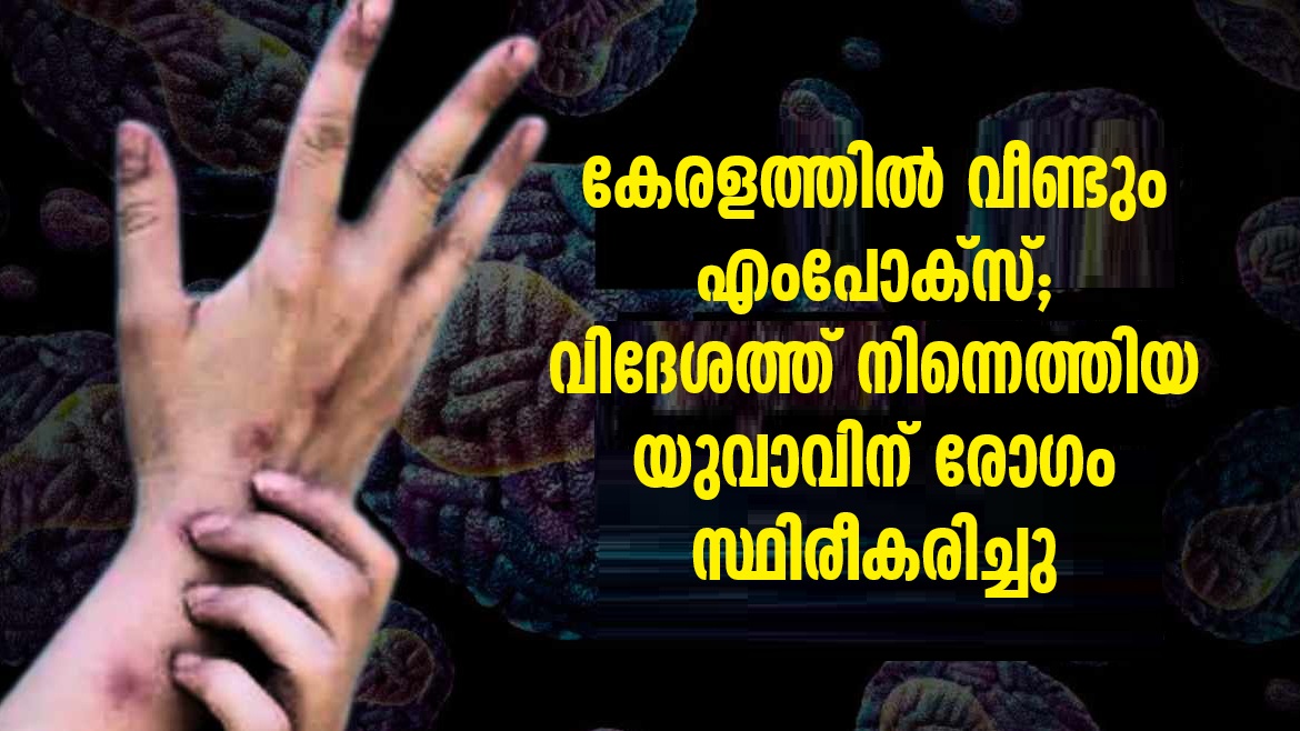 mpox again in Kerala; A young man who came from abroad has been diagnosed