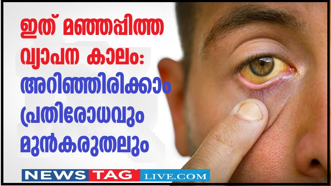 Jaundice Kerala Health Department tightens prevention