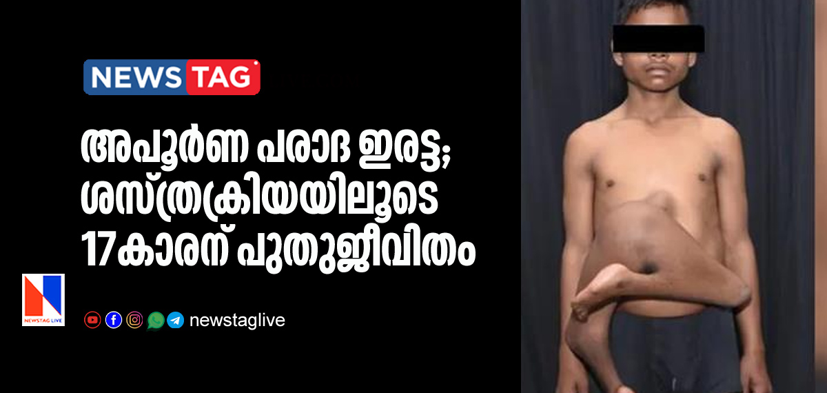 incomplete parasitic twin victim under went surgery to remove extra legs