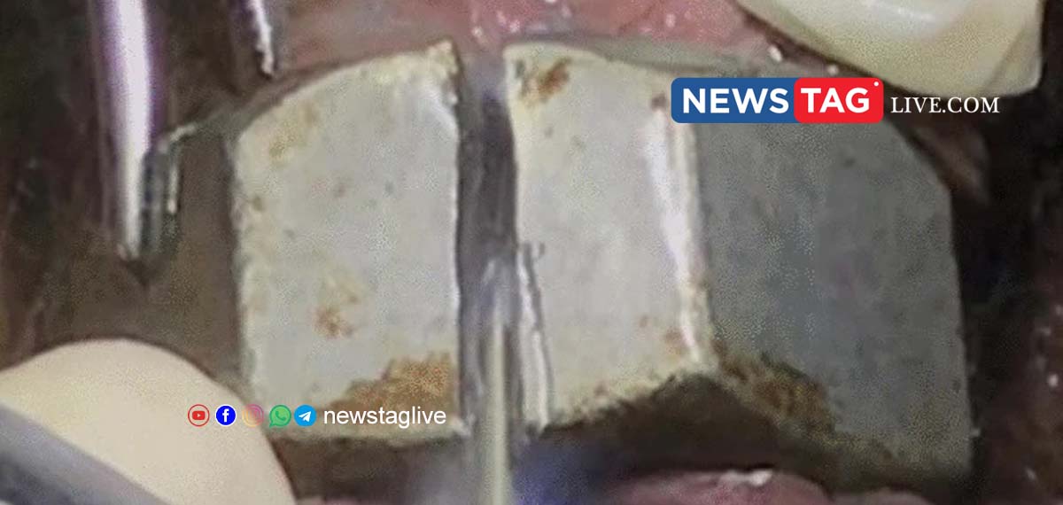 46 year old man gets metal nut stuck in his penis