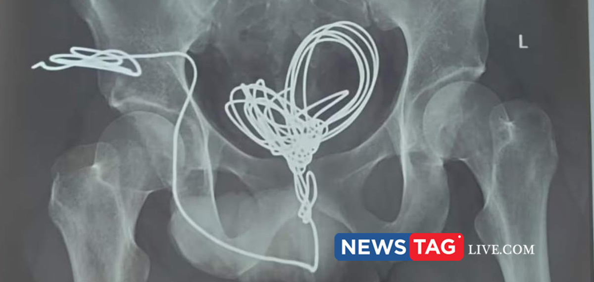 Thiruvananthapuram Medical college doctors saves man who insert 3 meter electric wire in to his genital