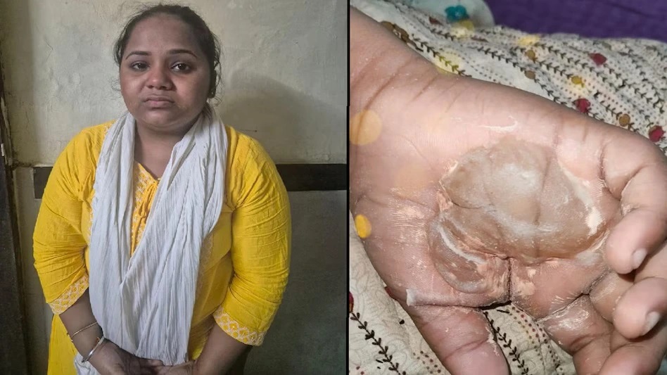Mumbai Tuition Teacher Arrested for Burning 8-Year-Old’s Hand with Candle as Punishment for Poor Handwriting