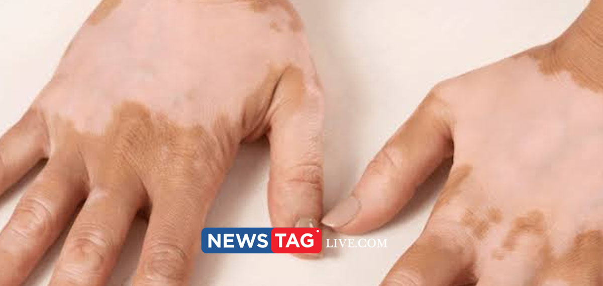 UAE approves oral tab treatment for Non-segmental Vitiligo